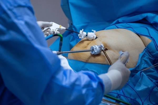 Bariatric (Weight Loss) Surgery